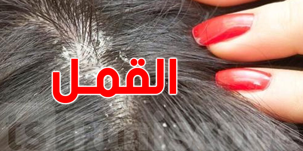 القمل ينتشر بين الصغار...طبيبة توضّح كيفاش ينتقل وكيفاش نقضيو عليه